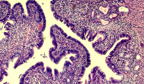 An example of the more aggressive endometriosis seen in women with the KRAS gene variant.