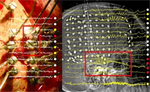 EEGs, a measurement of electrical activity in the brain, superimposed over images of the brain. The red boxes call out a possible epileptic episode.