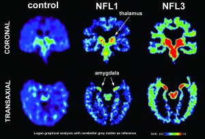 PET brain scans. Left image shows a normal brain scan; middle and right images show scans of pro football players from the study. Green and red colors demonstrate the higher level of tau protein found in the brain. Note the higher levels (more red and green) in the players' scans. Scans of the players in the study reflect differing levels of tau protein and follow a pattern of progression similar to the tau deposits that have been observed at autopsy in CTE cases. Image courtesy of David Geffen School of Medicine at UCLA (Click image to enlarge)