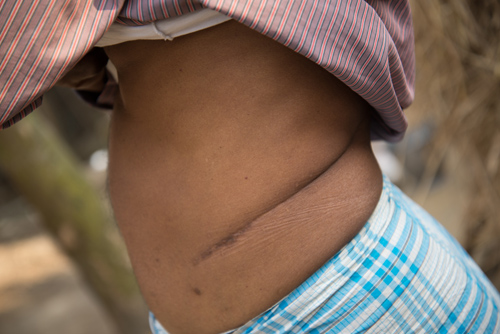 Janah Alam, a Bangladesh villager, displays his massive scar from selling his kidney to repay government loans. Photo by Kirk Mason