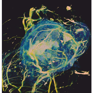 Tumors use large quantities of glucose to sustain their growth. By injecting normal, unlabeled sugar, UCL scientists have developed a way to detect its accumulation in tumours using magnetic resonance imaging (MRI). Image credit: UCL