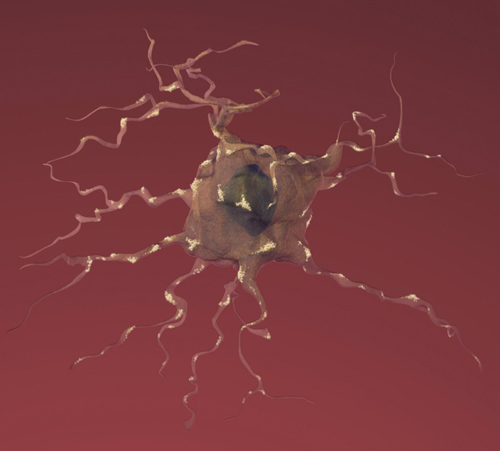 An artist’s rendition of nerve cell in the brain showing the ravages of Alzheimer’s disease. Image credit: National Institute of Aging