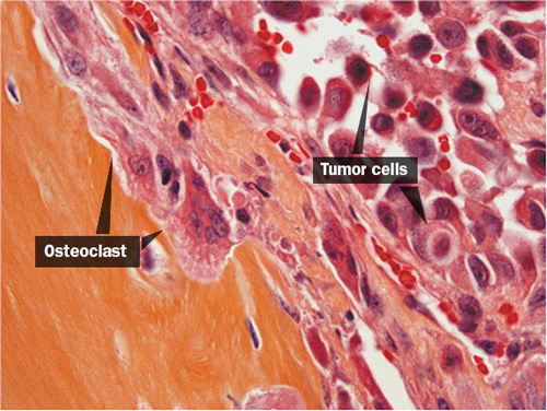 Researchers at Princeton University have found that microRNAs — small bits of genetic material capable of repressing the expression of certain genes — may serve as both therapeutic targets and predictors of metastasis, or a cancer’s spread from its initial site to other parts of the body. In this image, breast cancer cells (right) spread toward the hindlimb bone (left), using the host's own bone-destroying cells (osteoclasts) to continue their advance. (Image courtesy of Yibin Kang, Department of Molecular Biology)
