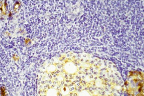 Beautiful death. Dead and dying metastatic prostate cancer cells (round light-colored area) inside a lymph node, surrounded by purple-stained lymphocytes of the immune system. Upper left and lower right corners: degenerating metastatic cells that still make prostate-specific antigen (PSA), which stains brown. Image credit: University of Minnesota