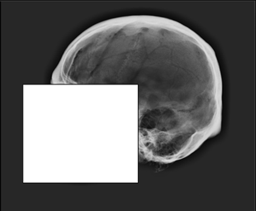 This X-ray image shows the cranial vault outline of a skull. Click to enlarge. Image credit: Ashley Maxwell