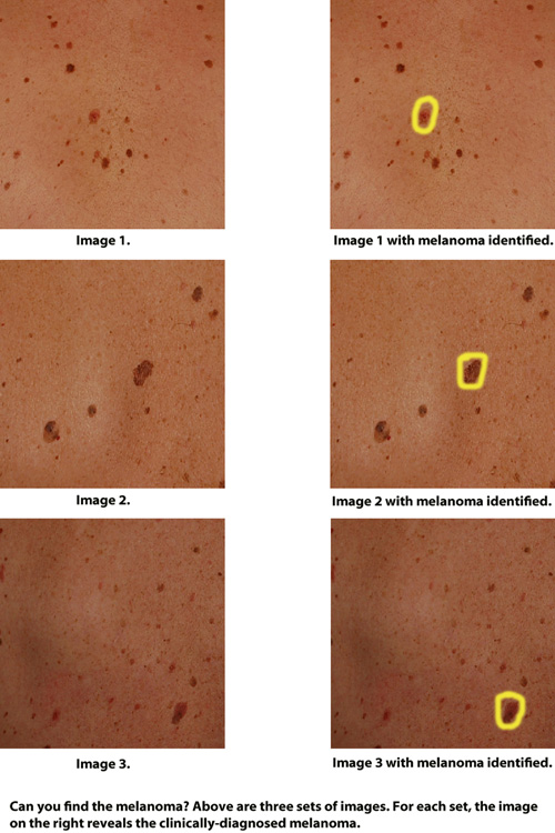 Images of melanoma identified. Photo Credit: Jakob Jensen 
