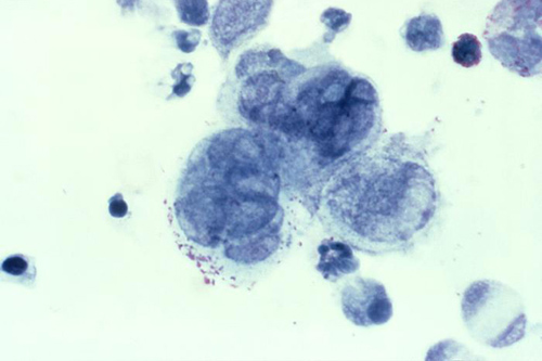 A micrograph of genital herpes virus within tissue removed from a genital sore. Image credit: CDC