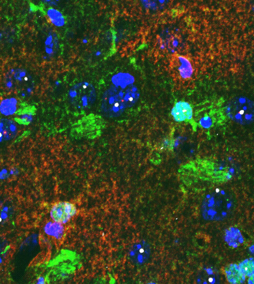 Astrocytes in brain tissue. Brain tissue from a mouse shows star-shaped astrocytes (green). Cells (blue) containing mutant protein (white) display lower levels of a potassium-regulating protein (red). Image credit: University of California