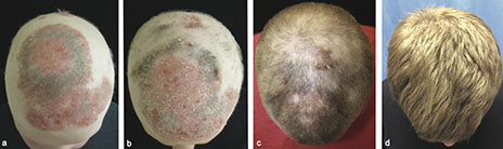 These panels show the patient's head a) before treatmen with tofacitinib, b) two months into treatment, c) five months into treatment, and d) eight months into treatment. Image credit: Yale University