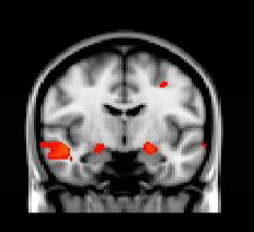 Amygdala activation (shown in red) in the left hemisphere of the brain was associated with PTSD symptoms following the Boston Marathon bombing. Image credit: Kate McLaughlin