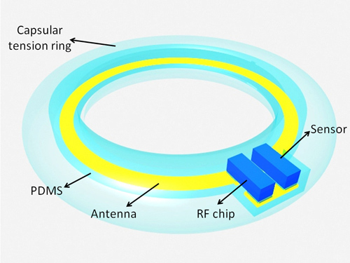 An illustration of the final device. The device would be placed in an artificial lens with its antenna circling the perimeter, and the sensor and radio frequency chip inside. Image credit: U of Washington