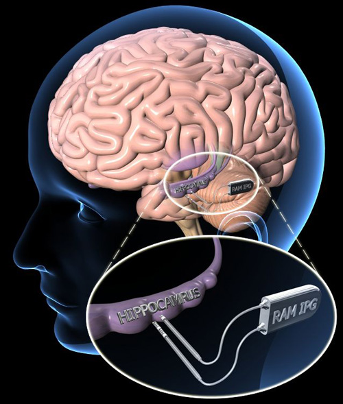 RAM device. Schematic illustration of the neuromodulation device designed to restore memory to be developed by UCLA RAM team. Image credit: UCLA