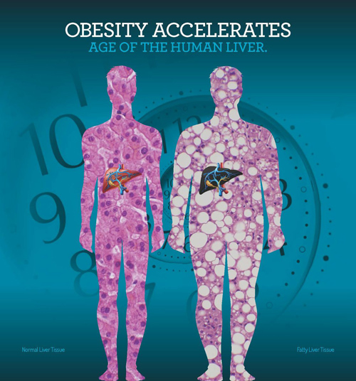 Obesity increases the age of liver. The patterns of the figures provides a microscopic view of liver cells from lean (left) and obese subjects. Image Courtesy of Steve Horvath