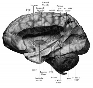 A camera lucida drawing made by E.J Curran depicts a postmortem dissection of the vertical occipital fasciculus. Curran described the VOF as “striking in its appearance, size, and complete isolation from the longitudinal fibers under it.” Image credit: Jason Yeatman (click image to enlarge)