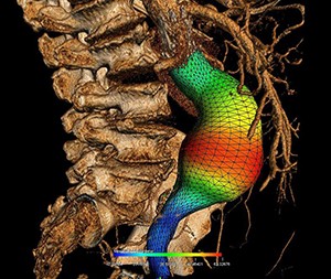 Three-dimensional reconstruction of an abdominal aortic aneurysm with colour representation of its diameter. Photo credit: CRCHUM.