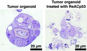 A section of a tumor organoid grown in vitro starting from cells derived from a patient with high-grade serous ovarian cancer (left) and a mini-tumor treated with ReACp53, resulting in extensive cancer cell death. Image credit: UCLA Jonsson Comprehensive Cancer Center (Click image to enlarge)