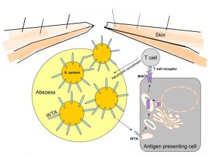 Das Zellhüllen-Zuckerpolymer Wandteichonsäure (WTA) von Staphylococcus aureus spielt bei der Entwicklung von Hautinfektionen eine Rolle. Besonders bei Infektionen mit hoch aggressiven sogenannten „Community-Associated Methicillin-Resistant Staphylococcus aureus“ (CA-MRSA), die einen im Gegensatz zu weniger aggressiven S. aureus Stämmen erhöhten WTA-Gehalt aufweisen, führt dies zu einer verstärkten Immunreaktion. Diese Immunreaktion beschleunigt die Ausbildung eines Abszesses der normalerweise die Infektion einschränken sollte, im Falle der CA-MRSA allerdings zu einem schwereren Infektionsverlauf beiträgt. Abbildung credit: Universität Tübingen (Click image to enlarge)