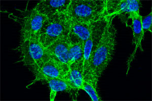 Lungenkrebszellen, in denen das Zellskelett (grün) und die Kerne (blau) angefärbt sind. Das Wachstum und die Aggressivität solcher Zellen könnten sich mit einem neuen Therapieansatz verringern lassen. Bild Quelle: Florian Weinberg 