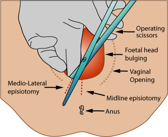 Medio-lateral episiotomy illustration. Image credit: Jeremy Kemp (Source: Wikipedia)
