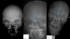 The skull on the left shows Stage 1 of frontal sinus development (circled in blue). The central skull shows Stage 2. Stage 3 is on the right. Image credit: North Carolina State University (Click image to enlarge)