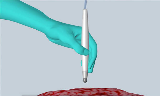 The MasSpec Pen rapidly and accurately detects cancer in humans during surgery, helping improve treatment and reduce the chances of cancer recurrence. Image credit: University of Texas at Austin